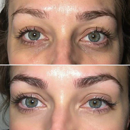 Korean Micro-needling Eye Patches