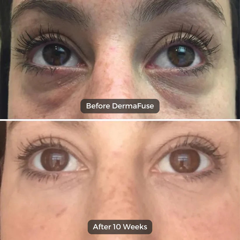 Korean Micro-needling Eye Patches